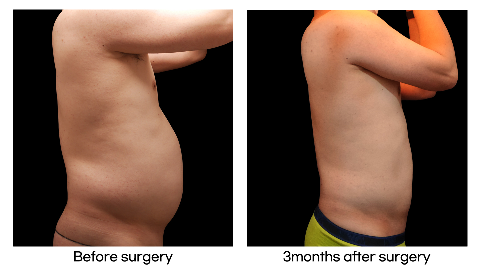 Meet Our Patients 43 Tummy Tuck in South Korea