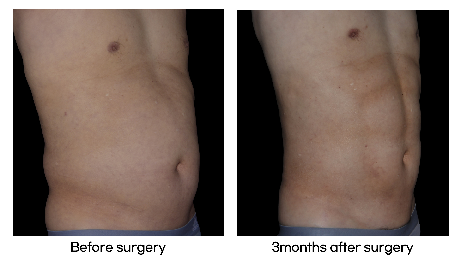 Meet Our Patients 45 Tummy Tuck in South Korea