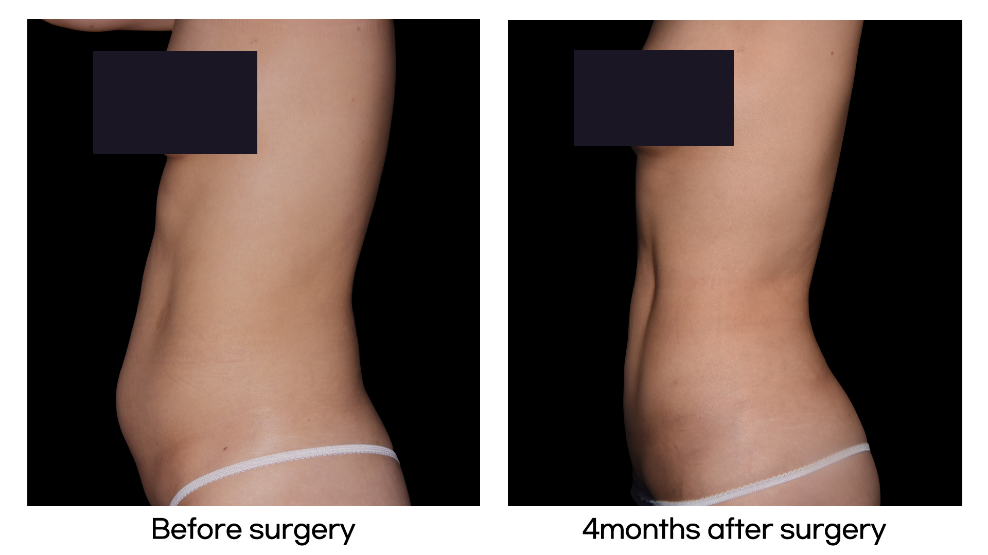Meet Our Patients 48 Tummy Tuck in South Korea