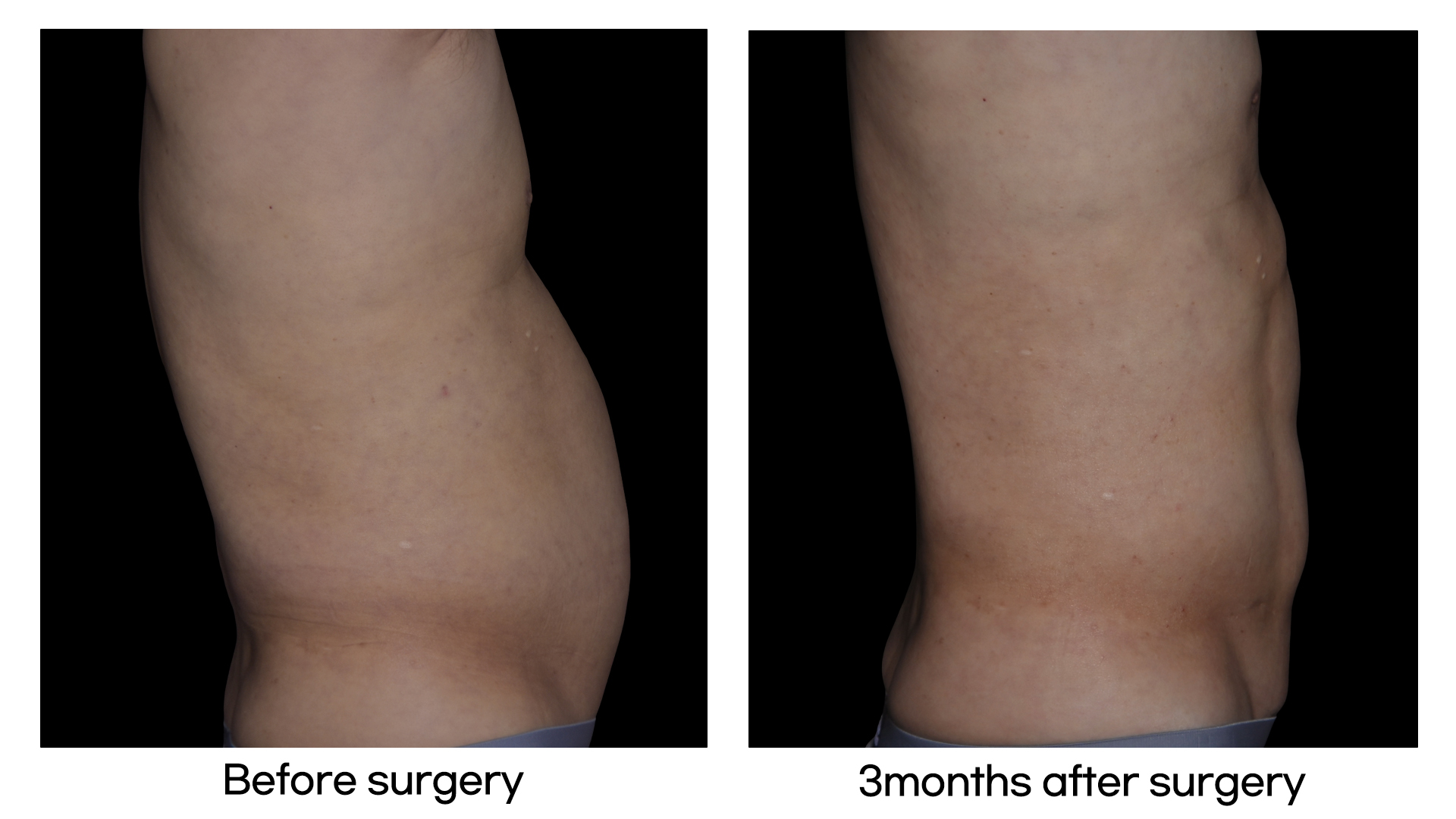 Meet Our Patients 46 Tummy Tuck in South Korea