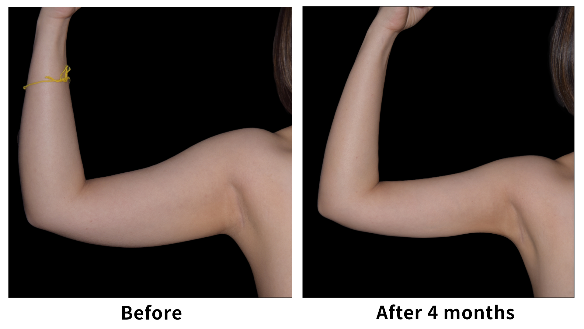 Meet Our Patients 68 arm slimming treatment korea