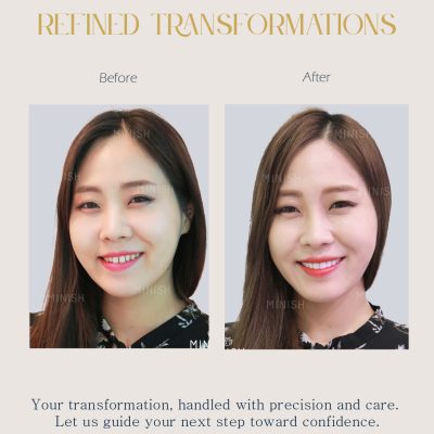 Home 14 Teeth Whitening Korea