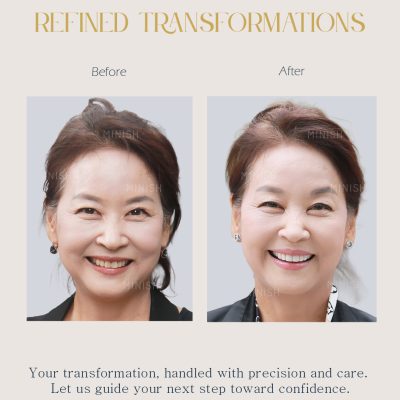 Home 17 Face rejuvenation treatment korea
