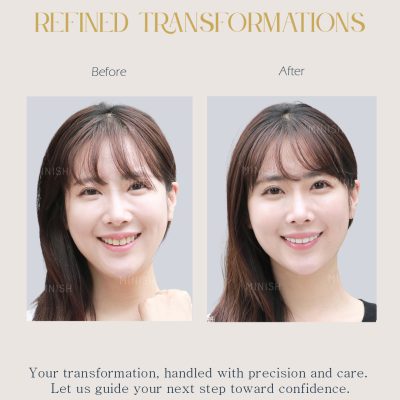 Home 21 Korean Jaw Surgery